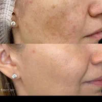 لک صورت بوتاکس خال موی سر ریش|خدمات آرایشگری و زیبایی|اهواز, کیان اباد|دیوار