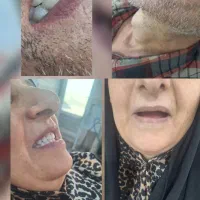 دندان مصنوعی اقتصادی