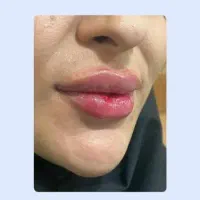 تزریق ژل و بوتاکس|خدمات آرایشگری و زیبایی|قم, صدوق|دیوار