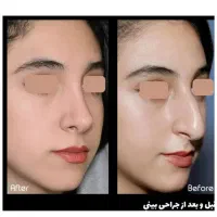 عمل بینی قسطی با ضمانت طبیعی بودن