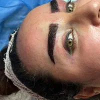 کاشت ابرو به روش fut زیر نظر پزشک