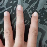 کلینیک بیماری ویروسی hpv و hsv