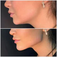 فیلر بادی/کانتورینگ صورت/تزریق چربی/بوتاکس/ژل لب|خدمات آرایشگری و زیبایی|تهران, تهرانپارس غربی|دیوار