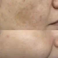 رفع تیرگی با پلاژن|خدمات آرایشگری و زیبایی|اهواز, فرهنگ شهر|دیوار