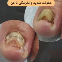 درمان ناخن های آسیب دیده (پدولوژی)