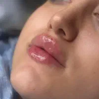 ژل لب ، چانه ، گونه و زاویه فک .بوتاکس