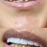 کامپوزیت با تخفیف ویژه