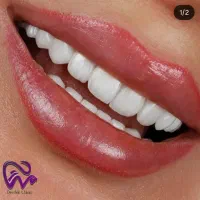 کامپوزیت دندان لبه شیشه ای اقساط بدون سود ،|خدمات آرایشگری و زیبایی|تهران, قیطریه|دیوار