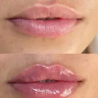 تزریقات زیبایی وجوانسازوفیلرها باتخفیف ویژه|خدمات آرایشگری و زیبایی|دوگنبدان, |دیوار