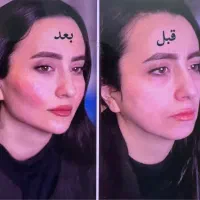 جشنواره تزریق چربی و ساکشن غبغب