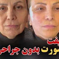 اندولیفت.لیپوفیس.ساکشن غبغب با اولترا زد|خدمات آرایشگری و زیبایی|مشهد, سناباد|دیوار