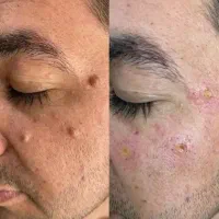 خال،میخچه،گوشت اضافه