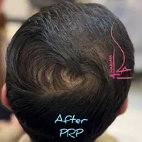 پی ار پی PRP ،مزوتراپی،اگزوزوم ولنجک،زعفرانیه|خدمات آرایشگری و زیبایی|تهران, محمودیه|دیوار