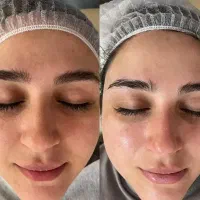 فیشیال.پاکسازی.مزو