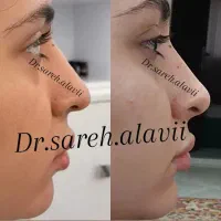 اصلاح فرم بینی بدون جراحی و بیهوشی توسط پزشک|خدمات آرایشگری و زیبایی|قم, دورشهر|دیوار