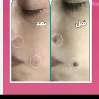 لیزرخال وزگیل منگوله های گوشتی بدون درد|پزشکی|دورود, |دیوار