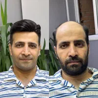 پروتزموطبیعی با نصب تخصصی و ارسال|خدمات زیبایی و سلامت|تهران, دولت‌آباد|دیوار