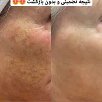قویترین ضد لک در ایران|آرایشی، بهداشتی، درمانی|بوشهر, |دیوار
