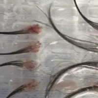 نیروی کات کار (کاشت مو)