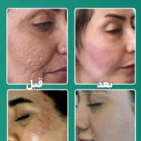 جلسه اول لیزر موهای زائد با کربن تراپی رایگان|خدمات آرایشگری و زیبایی|نجف‌آباد, شریعتی|دیوار