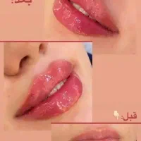 تخفیف ویژه تزریق فیلروبوتاکس باماندگاری بالا|خدمات آرایشگری و زیبایی|فلاورجان, |دیوار
