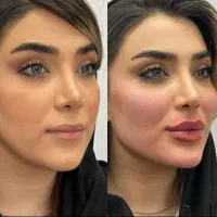 بوتاکس لیفت صورت فیلربادی بلفارو فیلرزاویه سانترال|خدمات آرایشگری و زیبایی|اصفهان, میرعماد|دیوار