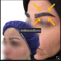 بلفاروپلاستی کاشت ابرو کاشت مو تخفیف|خدمات آرایشگری و زیبایی|تهران, دریاچه شهدای خلیج فارس|دیوار
