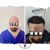 کاشت مو با شرایط اقساط تضمینی|خدمات آرایشگری و زیبایی|اردبیل, |دیوار