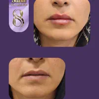 بوتاکس رایگان