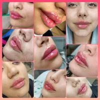 فیلرژل لب،ژل وبوتاکس تخصصی آقاوخانم در مطب پزشک|خدمات آرایشگری و زیبایی|شیراز, قصرالدشت|دیوار