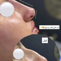 لیفت بینی NOA بدون جراحی بدون عمل و نقاهت