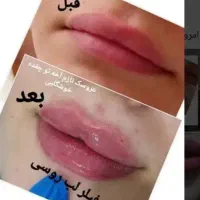 فیلر ژل لب و صورت و بوتاکس