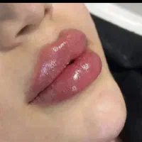 مزو.بوتاکس.ژل.