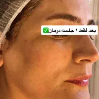 فیشال تخصصی بانوان وآقایان،خالبرداری،حذف کک ومک|خدمات آرایشگری و زیبایی|شیراز, عفیف‌آباد|دیوار