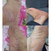 بهبود صدرصد طبیعی عوارض بدن|آرایشی، بهداشتی، درمانی|حمیدیه, |دیوار