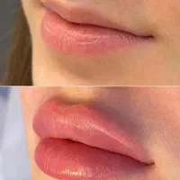 خدمات ژل بوتاکس فیلر آنزیم مزوتراپی مزوژل