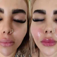 فیلر بادی و ژل و بوتاکس