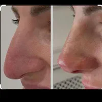 طراحی لیفت بینی وفرمدهی عملی(بدون جراحی)پزشک متخصص|خدمات آرایشگری و زیبایی|مشهد, سناباد|دیوار