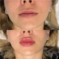 ژل و فیلر و آنزیم و (بوتاکس این هفته ۷۰۰)توسط پزشک