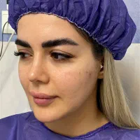 بلفاروپلاستی با ظریفترین نخ