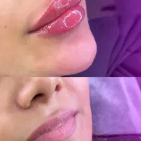 تزریق ژل و بوتاکس تخصصی|خدمات آرایشگری و زیبایی|اندیشه, اندیشه فاز ۱|دیوار