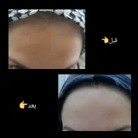 جوش لک و چین چروک امانت بریده|آرایشی، بهداشتی، درمانی|اهواز, آریاشهر|دیوار