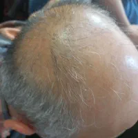 رفع  ریزش مو و رویش مجدد