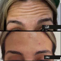 ژل و بوتاکس برای خانم ها و آقایان