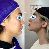 جراحی غبغب لیپوساکشن سوپرکانتور اندولیفت بوکال فت