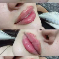 آموزش و تزریق ژل وبوتاکس با جدیدترین متد روز