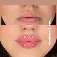 بوتاکس رایگان