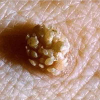 زگیل تناسلی زیگیل خال میخچه درمان hpv