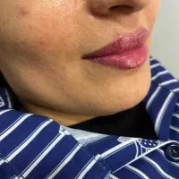 تزریق ژل و بوتاکس