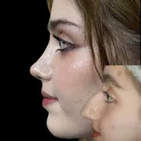 عمل بینی فقط ۲۸ تومن تضمینی/پیکرتراشی/اسلیو/لیفت